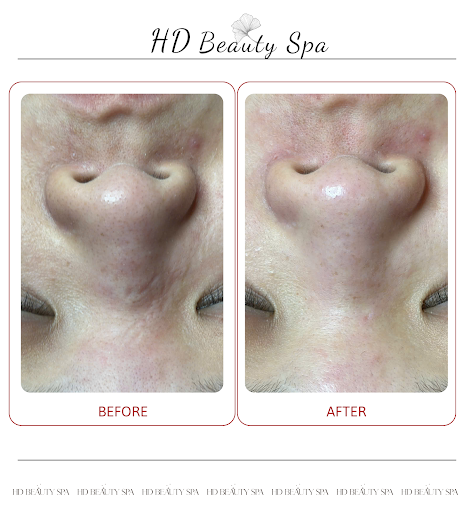 HD Beauty Spa | Trị Mụn Hiệu Quả An Khánh | Chăm Sóc Da Uy Tín Thủ Đức photo 8 in Thao Dien