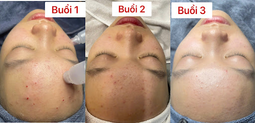 MILK SKIN BEAUTY | Spa Nặn Mụn Gần Đây | Gội Đầu Dưỡng Sinh Gần Đây | Spa Gần Đây photo 3 in Thao Dien