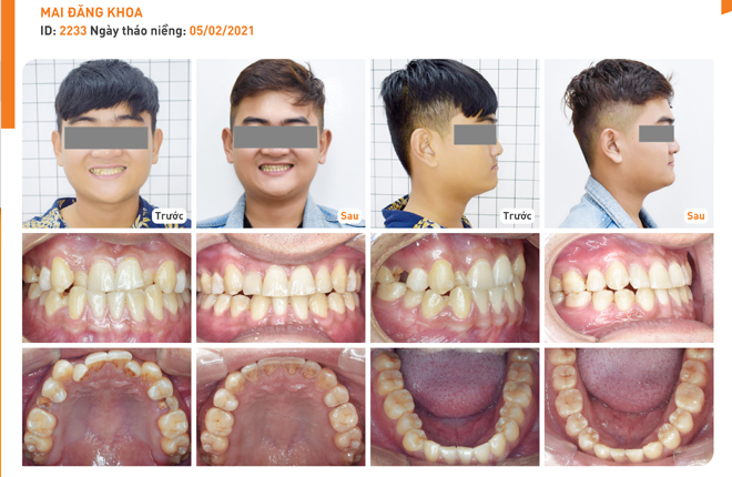 Niềng Răng Chuyên Sâu Up Dental photo 3 in Thao Dien