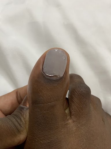 A close-up image of a person's fingernail showing signs of damage or infection at the nail bed.